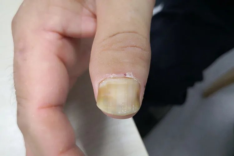 灰指甲早期症状图