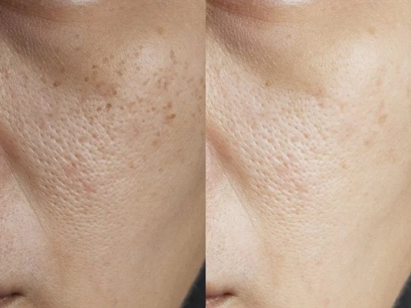 抗氧化美白针的作用