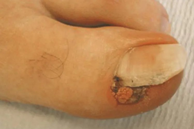 寻常疣脚趾甲肉球图片