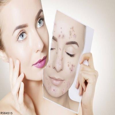 额头长痘的原因有哪些 四大原因造成你长痘困扰