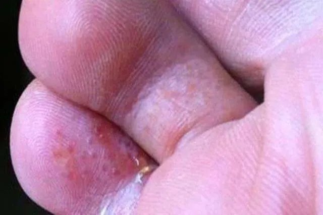 水泡型的足癣图片