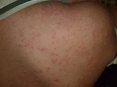 皮肤蝇蛆病症状图片