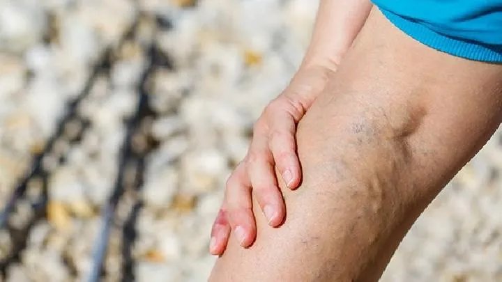 精索静脉曲张的危害有哪些?