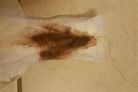 宫颈癌血性白带图片