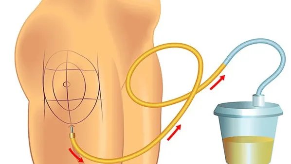 吸脂减肥的危害是什么
