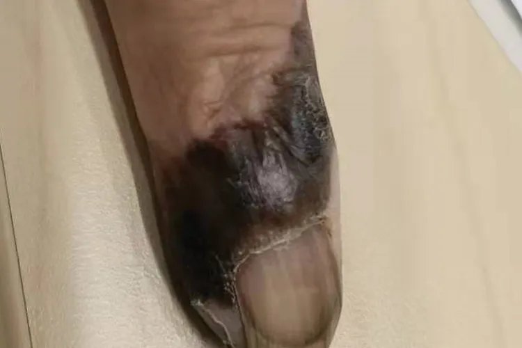 黑色素瘤早期症状图片