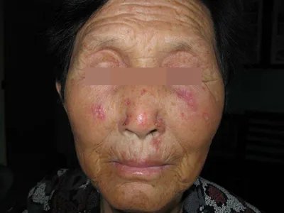 盘状红斑狼疮红斑图片