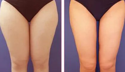 腿部吸脂手术价格是多少钱