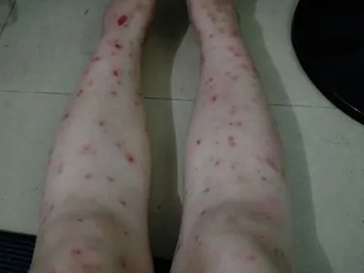 跳蚤叮咬疙瘩图片