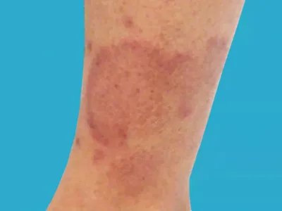 盘状红斑狼疮红斑图片