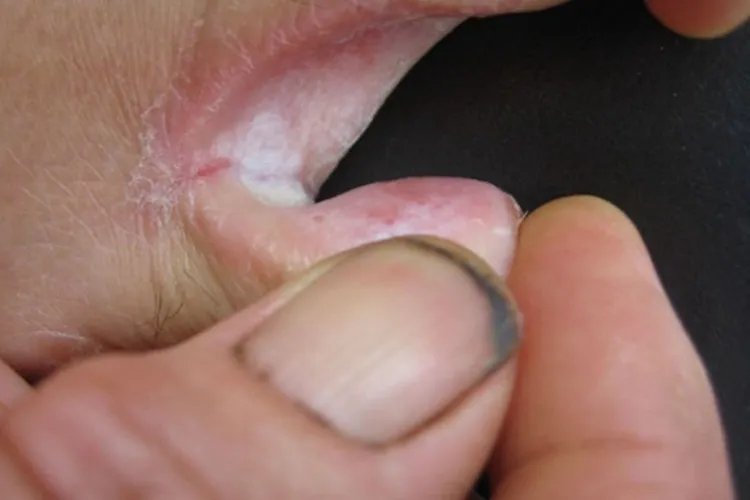 真菌性脚癣图片