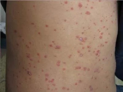 北京哪个医院看皮肤好【北京京城皮肤病医院】