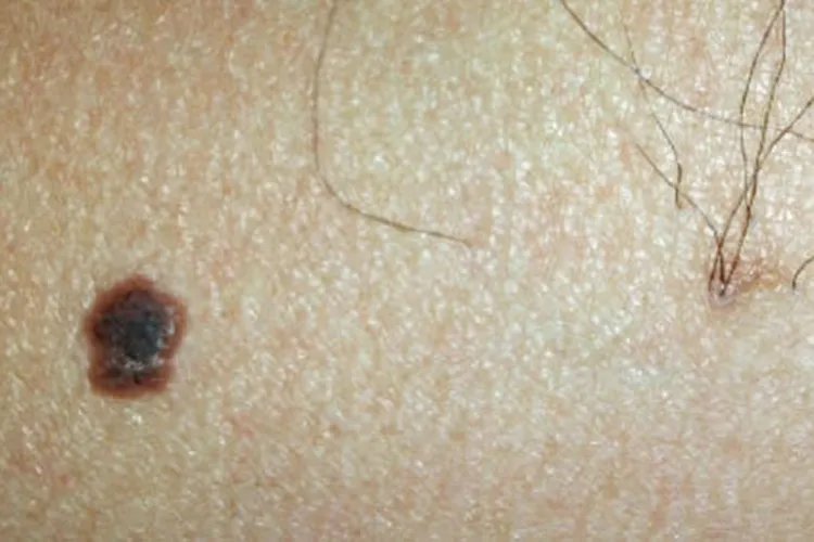 正常痣的样子图片