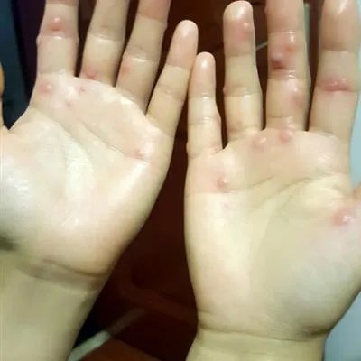 风疹病毒阳性怎么治疗