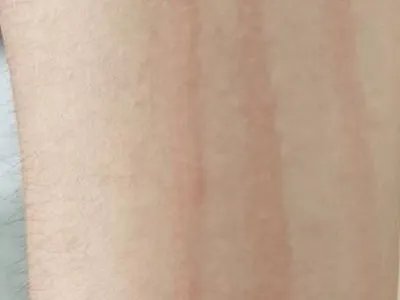 人工荨麻疹症状图片