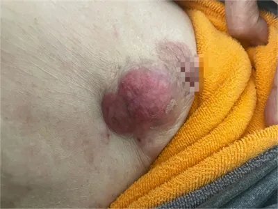 乳腺癌症状图片