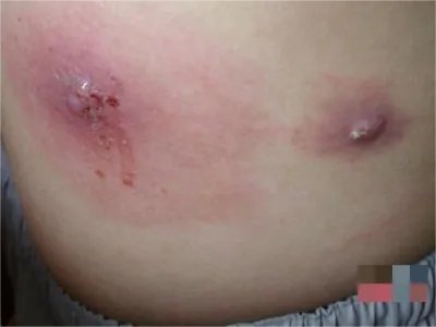 皮肤蝇蛆病症状图片