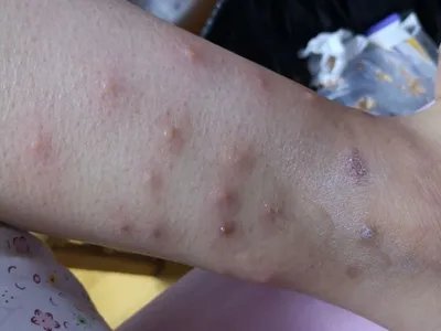 跳蚤叮咬疙瘩图片