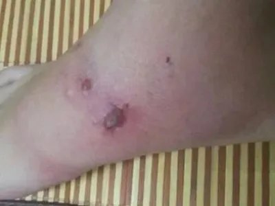 蠓虫叮咬引起的皮肤反应小腿结痂图片