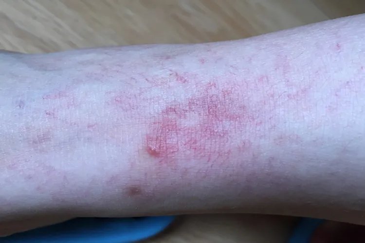 乙肝初期小红点图片