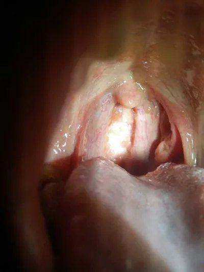 食管憩室是什么意思?