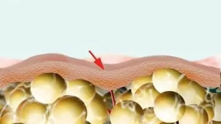 生活中如何预防橘皮纹呢？