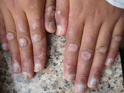 盘状红斑狼疮红斑图片