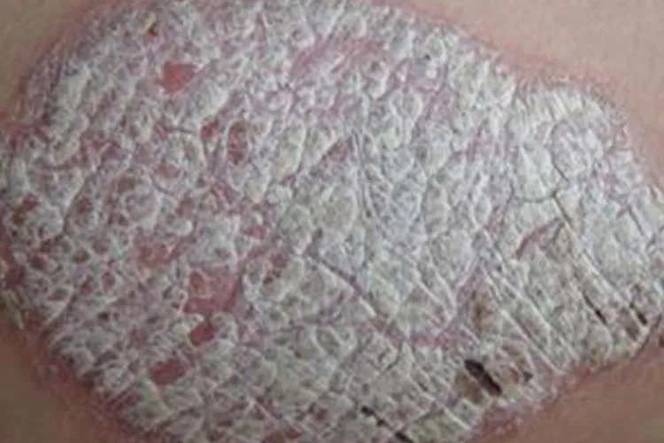 点滴状银屑病三个阶段图片