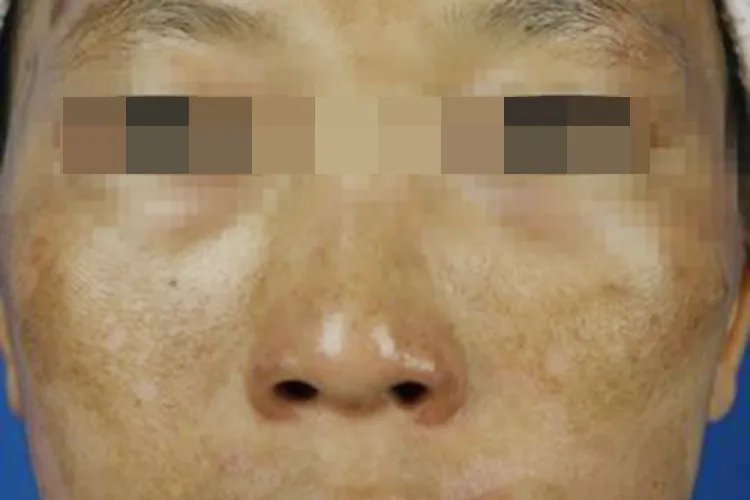 脸上蝴蝶斑图片