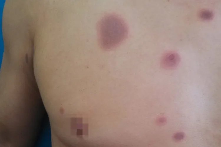 皮丘疹图片大全