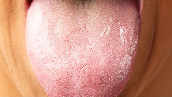 舌苔厚黄是怎么回事