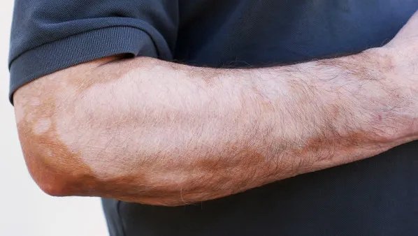 得了白癜风怎么办