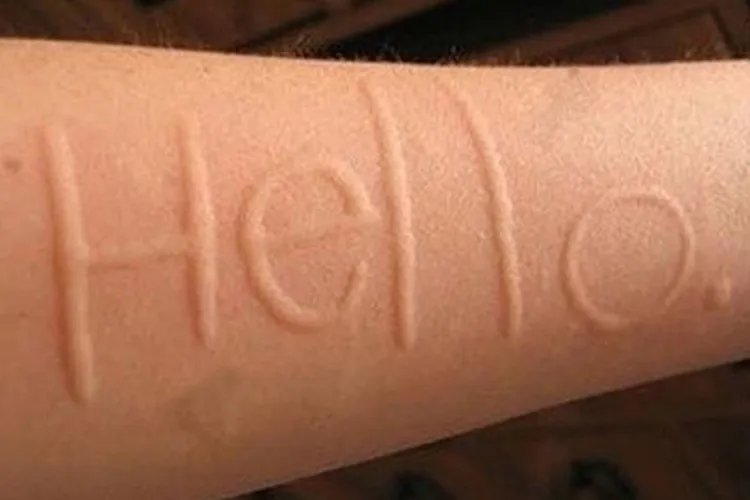 荨麻疹图片和症状图