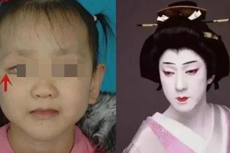歌舞伎面谱综合征患者图片