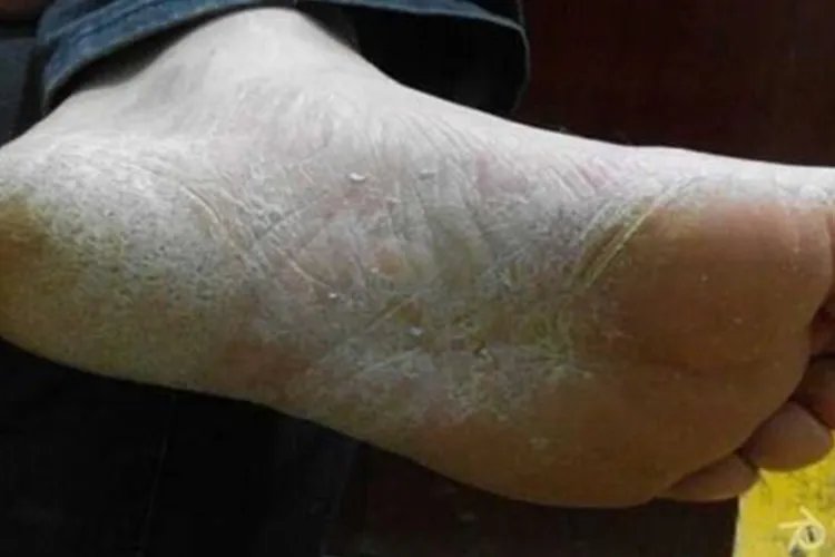 真菌性脚癣图片