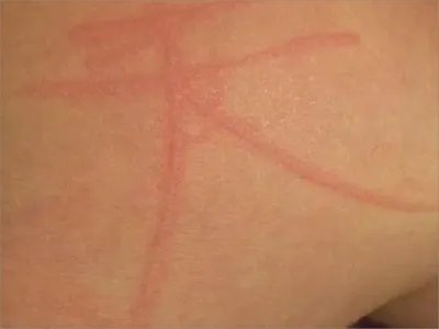 人工荨麻疹症状图片