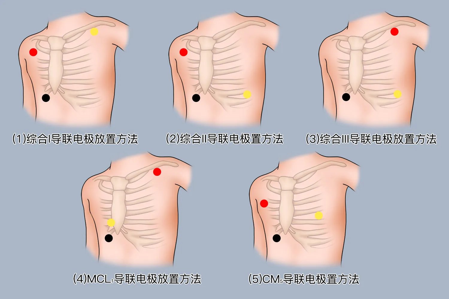 心电监测的电极位置