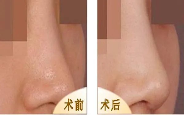 天津整形医院哪家做隆鼻好