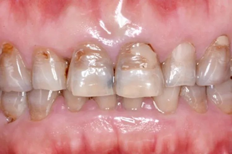 四环素牙牙齿症状图片