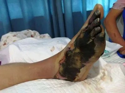 气性坏疽症状图片