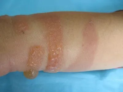 皮肤过敏红肿胳膊症状图片