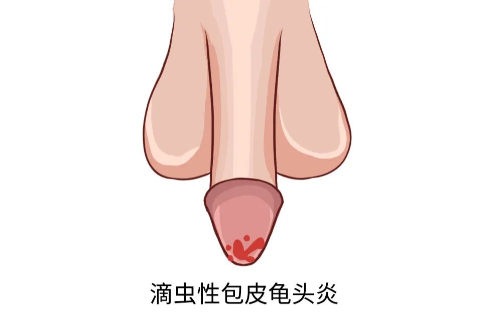 4种龟头炎图片