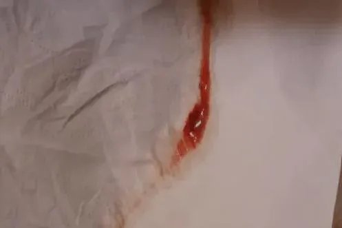 宫颈癌血性白带图片