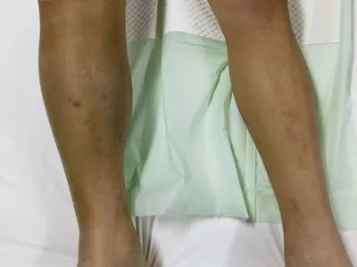 气性坏疽症状图片