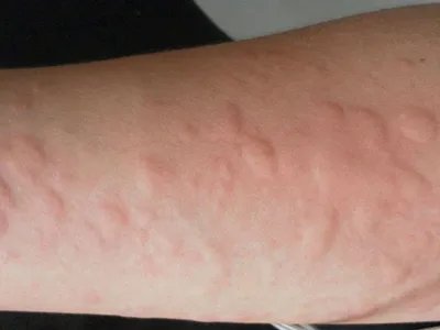 皮肤过敏红肿胳膊症状图片