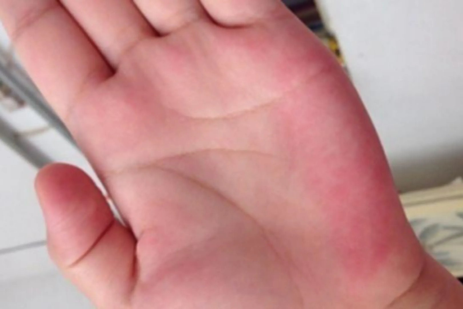 手诊看疾病图解