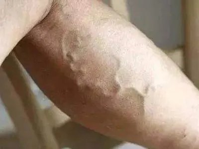 皮肤蝇蛆病症状图片