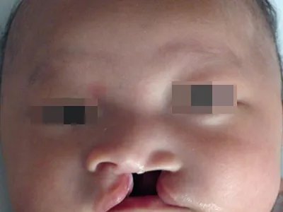 唇腭裂症状图片