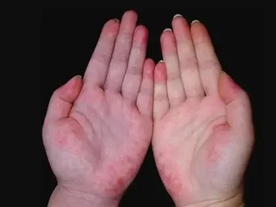 盘状红斑狼疮红斑图片