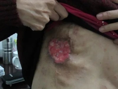 乳腺癌症状图片